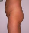 This is a 38 y.o. woman wanted to have a buttock augmentation
