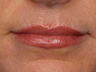 Botox