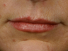 Botox