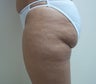 50 Year Old Female for Liposuction of Thighs and Hips