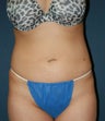 Smart Lipo
