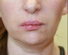 Filler in nasolabial folds (Juvederm)