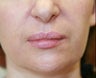 Filler in nasolabial folds (Juvederm)