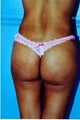 brazilian butt lift