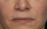 JUVEDERM ULTRA PLUS