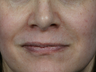 JUVEDERM ULTRA PLUS