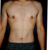 Vaser Liposuction 