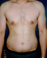 Vaser Liposuction 