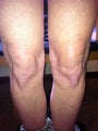 Laser Liposuction and Mixto CO2 laser of Knee 