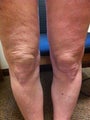 Laser Liposuction and Mixto CO2 laser of Knee 