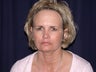 Endoscopic Brow Lift
