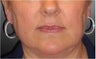 Juvederm