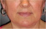 Juvederm