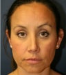 Crooked Nose Rhinoplasty