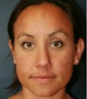 Crooked Nose Rhinoplasty