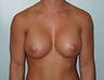 Female patient who underwent a breast augmentation with implants 