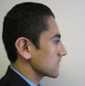 Rhinoplasty