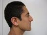 Rhinoplasty