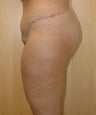 Body Lift