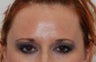 Caucasian Female Underwent Botox