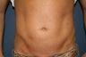 Smart Lipo