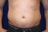 Smart Lipo