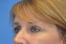 Endoscopic Browlift, SMAS Facelift and Necklift, Chin Implant