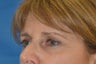 Endoscopic Browlift, SMAS Facelift and Necklift, Chin Implant