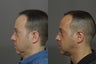 Chin Implant