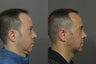 Chin Implant