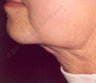 LipoDissolve injections to neck fat