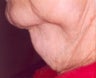 LipoDissolve injections to neck fat