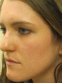 Acne Scars Treatment