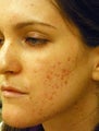Acne Scars Treatment