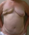 64-year-old female with right delayed DIEP flap breast reconstruction