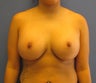23 year old for no breast scar trans axillary submuscular saline breast augmentation