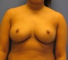 23 year old for no breast scar trans axillary submuscular saline breast augmentation