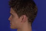 Rhinoplasty