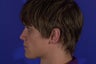 Rhinoplasty