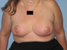 woman underwent a Breast Reduction procedure.