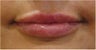 Lip Augmentation