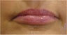 Lip Augmentation