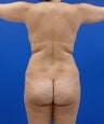 Brazilian Butt Lift 