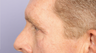 Bilateral eyelid surgery 