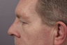 Bilateral eyelid surgery 
