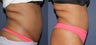 Before & After Liposonix