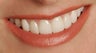 Porcelain Veneers