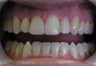 Porcelain Veneers