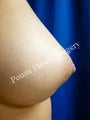 Nipple-Areola Repair