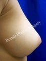 Nipple-Areola Repair